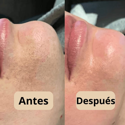 Peel Shot - Elimina las Impurezas y Realza la Belleza de tu Piel