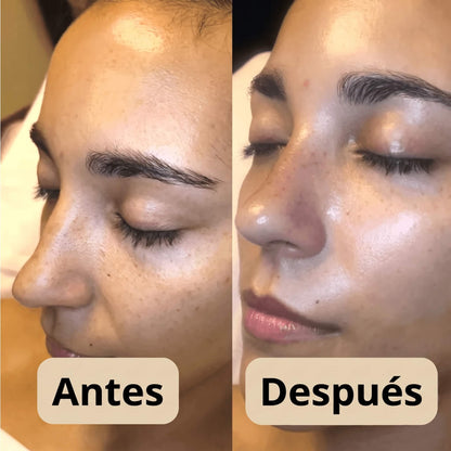 Peel Shot - Elimina las Impurezas y Realza la Belleza de tu Piel